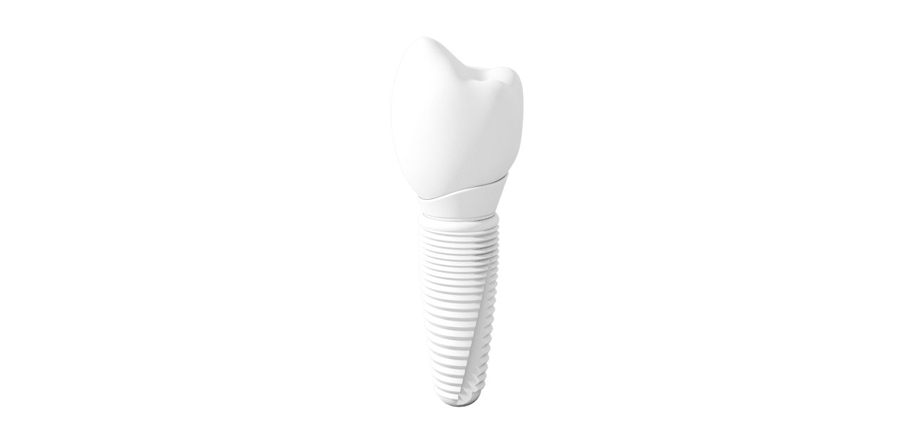 Non-Metal Dental Implants